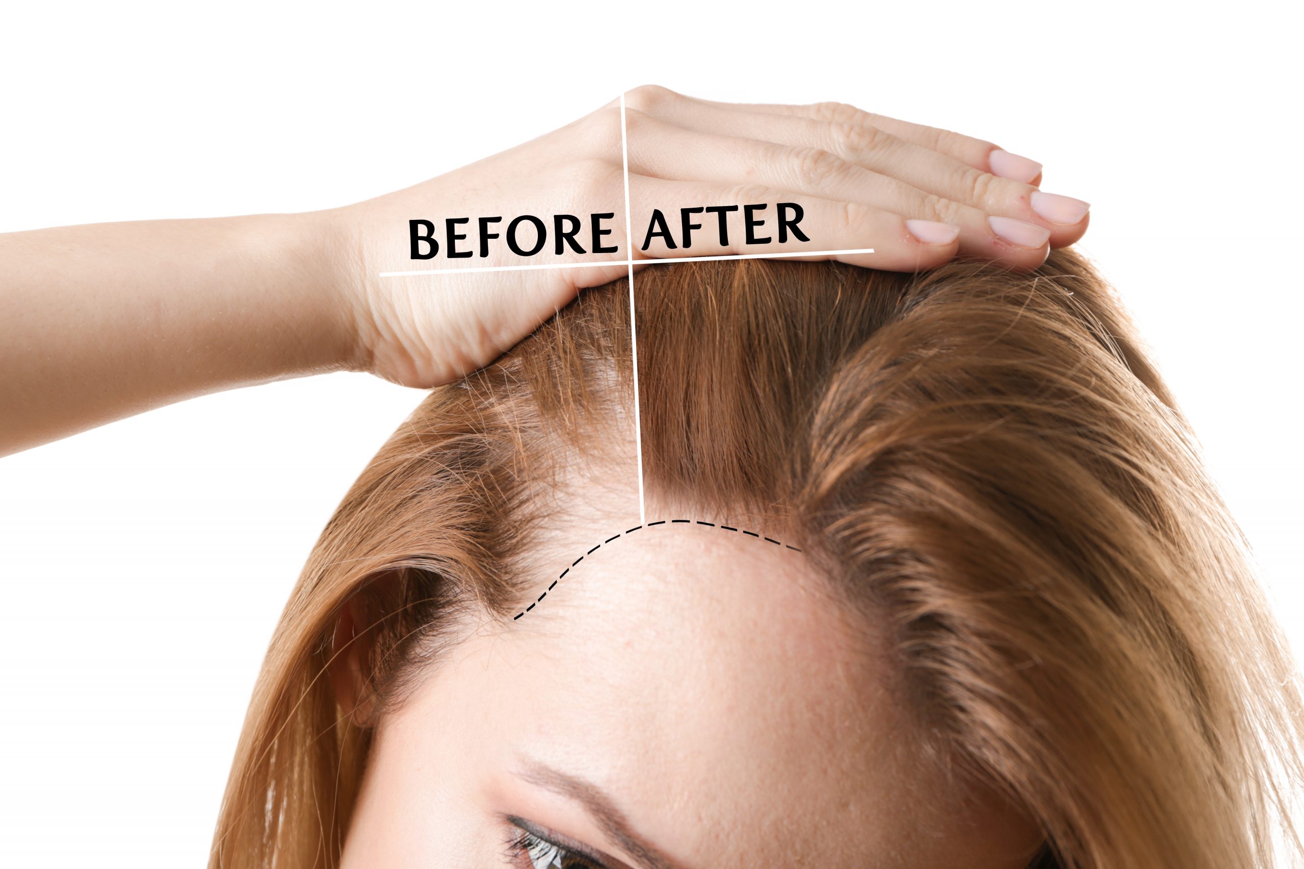 Surgical hair restoration